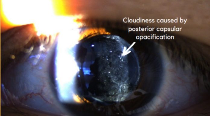 Dr Claudine Pang’s Guide to After-Cataract Surgery (2025) Picture of a patient's eye suffering from PCO